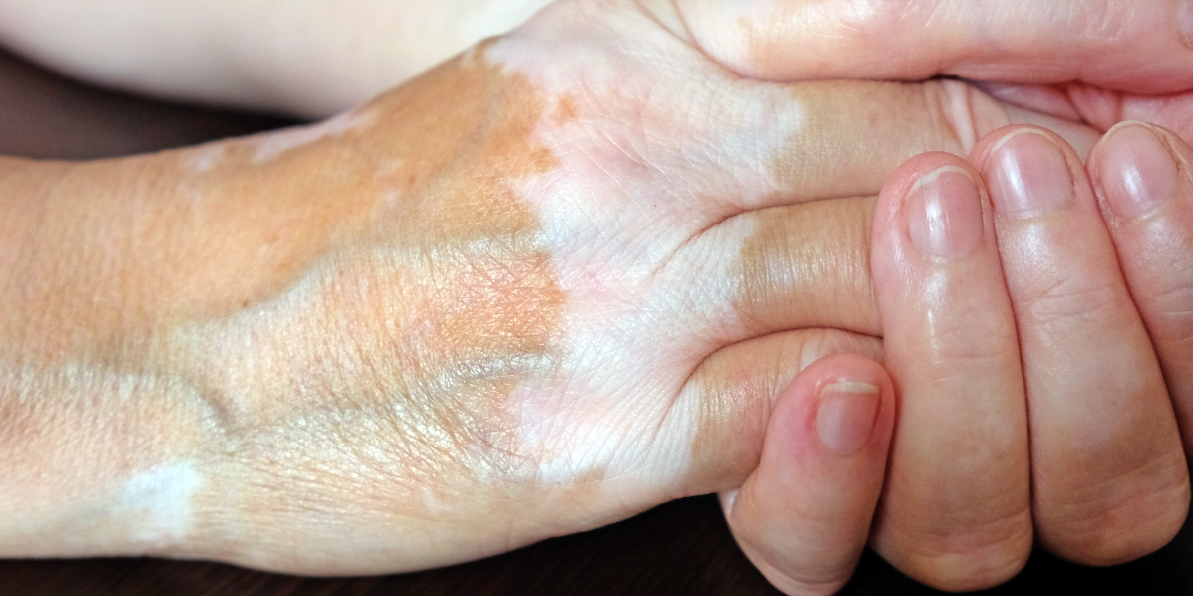 Vitiligo