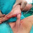 Before procedure 2