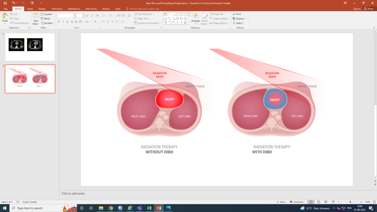 Deep Inspiratory Breath Hold Dibh Modern Technique In Breast Cancer