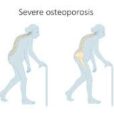 osteoporosis 1666706083451