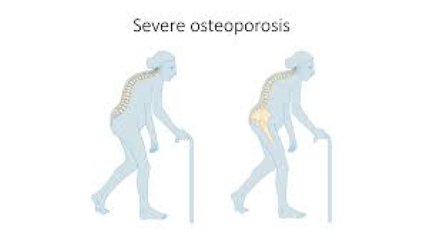 osteoporosis 1666706083451