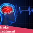 Stroke Treatment
