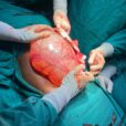 Cyst