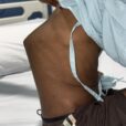 8 Year Old Boy Walks Again After High Risk Surgery for Advanced Spinal Tuberculosis