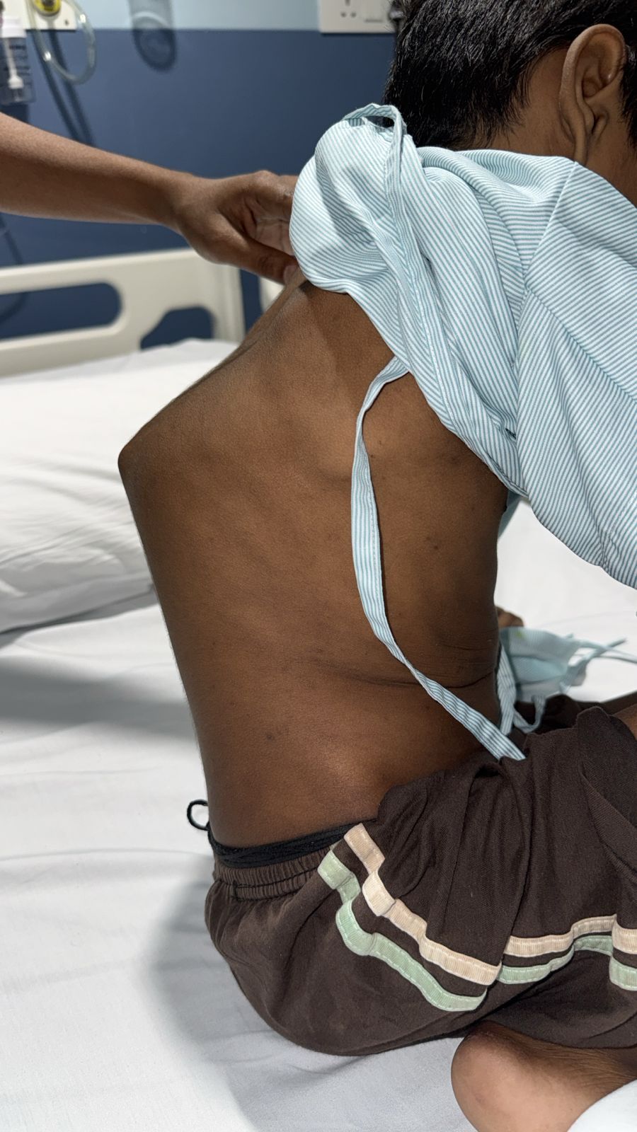 8 Year Old Boy Walks Again After High Risk Surgery for Advanced Spinal Tuberculosis